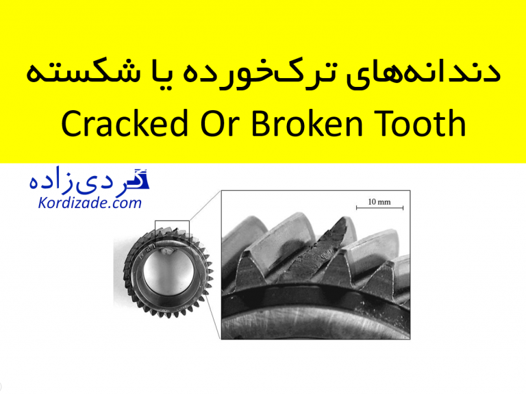 دندانه‌های ترک‌خورده یا شکسته